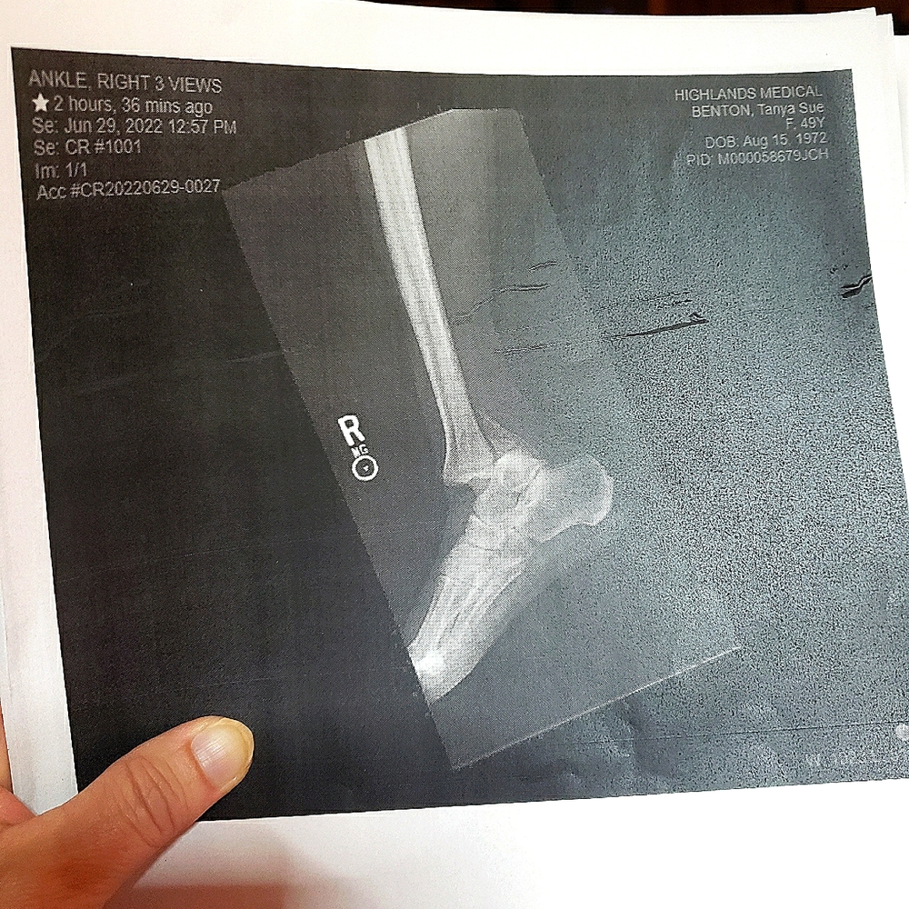 Underwent emergency surgery July 2nd unable to drive.